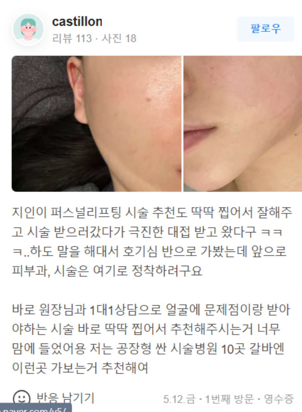 울쎄라 수면마취 없이 원장이 직접 시술받은 후기 관련 이미지 19