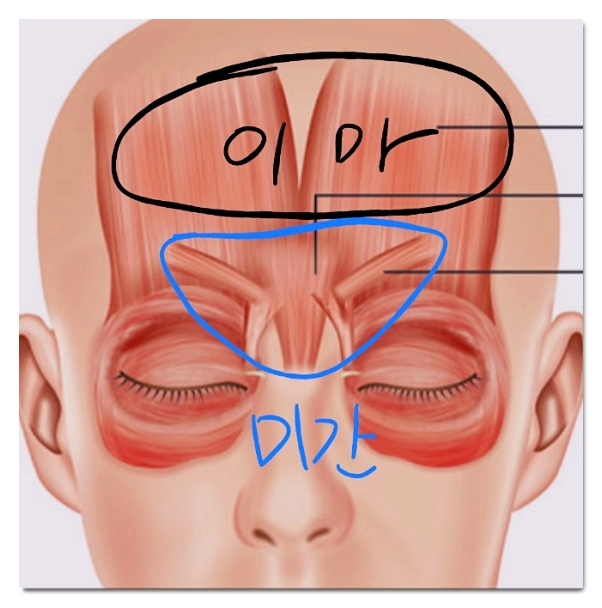 Hongdae Botox: How to Avoid Regretting Choosing a Clinic Just Because It’s Cheap (What to Look For) image 3
