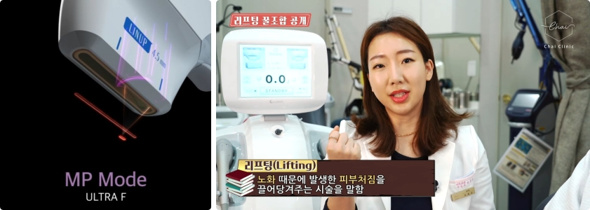 눈가 리프팅 탄력=기술력 어떻게 확인할까요?!😊 관련 이미지 10