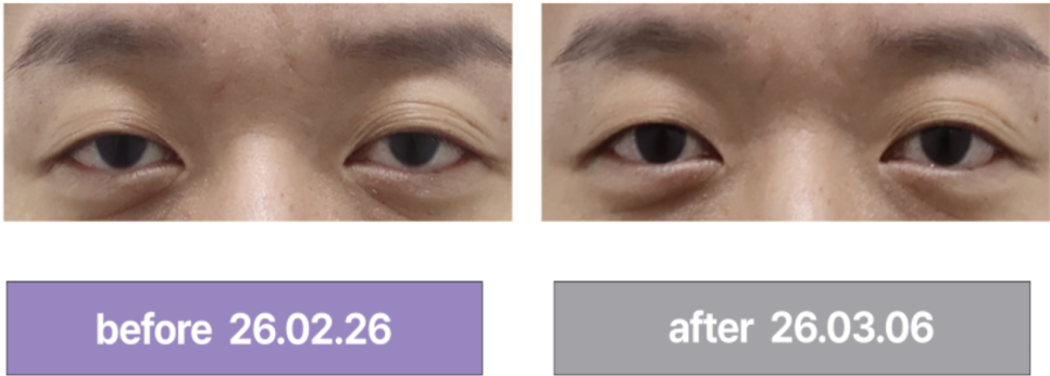Why Iseurf Uses a Dedicated Eye-Area Tip for Wrinkles Around the Eyes image 10
