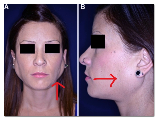 Read This Before You Regret Getting Salivary Gland Botox in Hongdae image 4