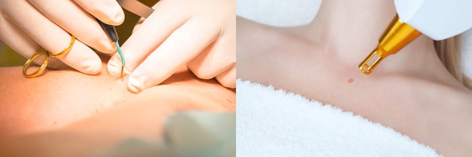얼굴 빽빽하게 뒤덮은 사마귀 레이저로 박살 내기 관련 이미지 8