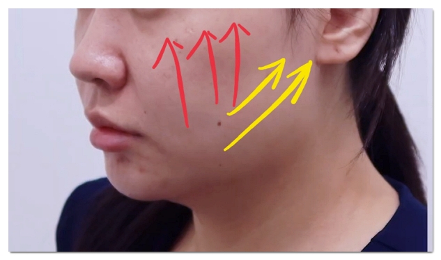 합정 울쎄라 효과 없었던 이유 4가지 관련 이미지 4