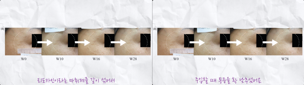 남자 물광주사 작은 차이로 만드는 드라마틱한 효과 관련 이미지 9