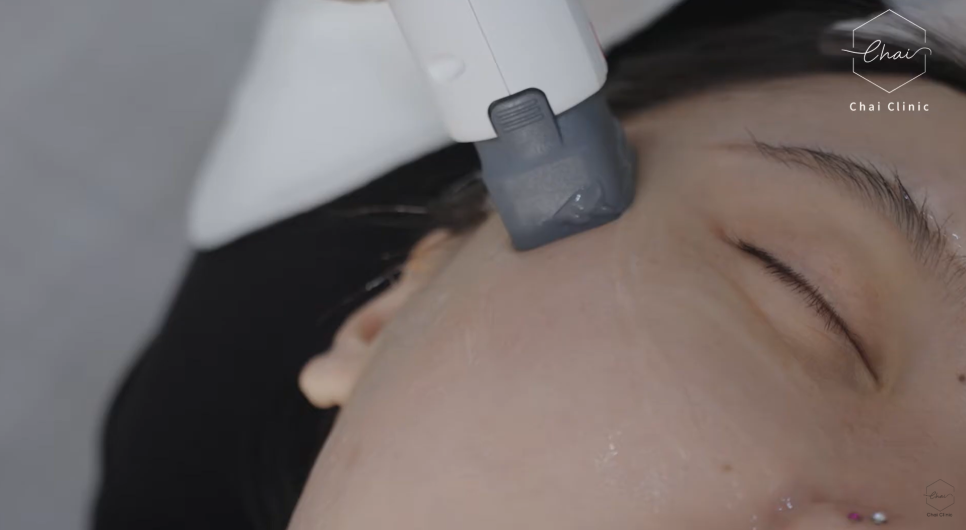Why Iseurf Uses a Dedicated Eye-Area Tip for Wrinkles Around the Eyes image 9