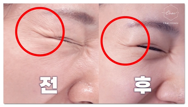 Three Major Side Effects of Hongdae Shurink and How to Fix Them image 9