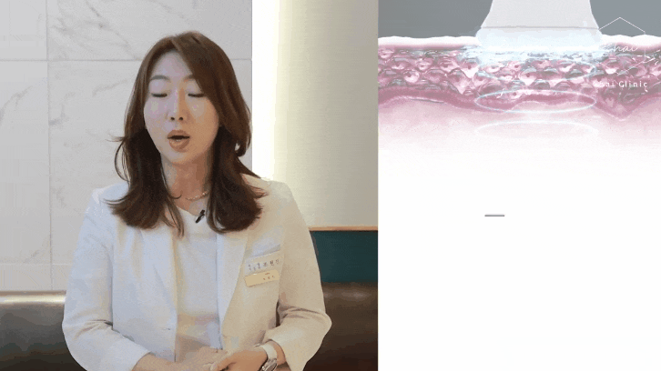 V라인리프팅, 일상생활 걱정 하지마세요! 관련 이미지 4