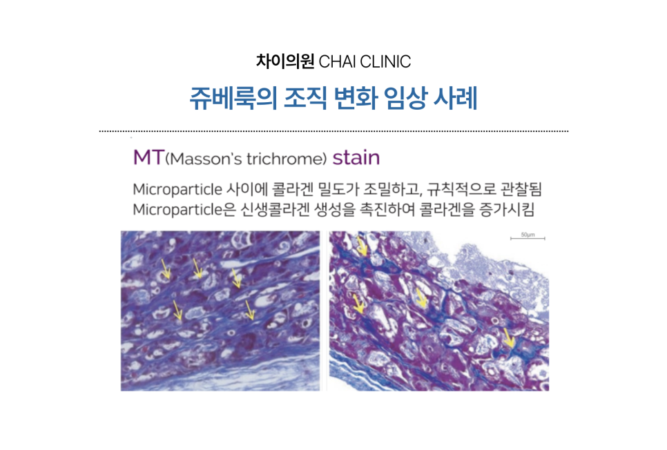 합정피부관리 차이의원의 단계별 체계적인 쥬베룩 흉터 치료 관련 이미지 7