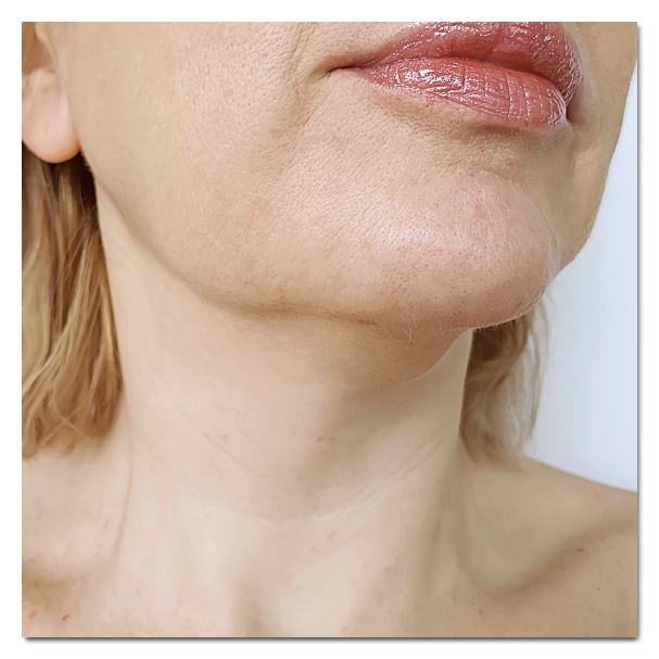 Can You Get Ulthermage in Hongdae? Selection Criteria by Face Type image 2