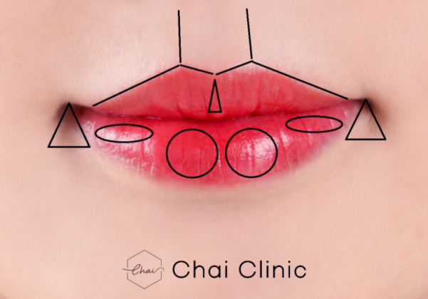 Hongdae Lip Filler: A Complete Guide to Pain, Swelling, and Design Before and After image 2