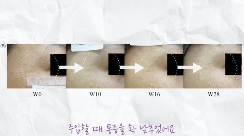 리쥬란 HB 통증에 대한 견해 관련 이미지 4