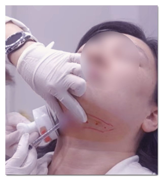 홍대 지방분해주사 복부, 팔뚝, 이중턱 시술 결과는? 관련 이미지 2