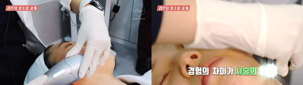 홍대인모드 요즘 가장 핫한 리프팅 시술 효과도 핫하려면? 관련 이미지 7