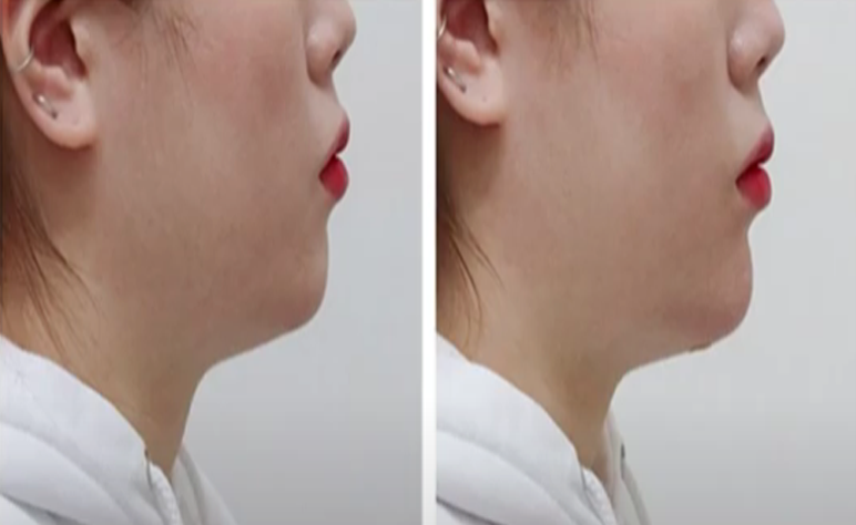 마포 필러 고민중이라면 하기 전에 꼭 읽어보고 진행해 주세요. 관련 이미지 2