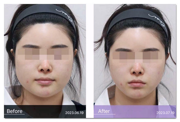 합정역 보톡스, 가격보다 관련 이미지 8