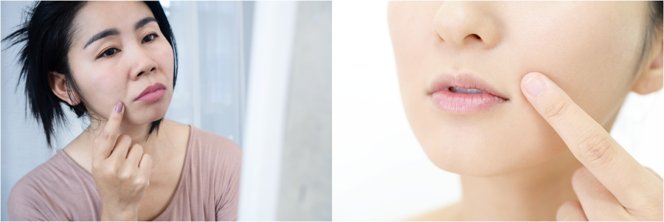 팔자 리프팅 필러 고민중이라면 주목해주세요! 관련 이미지 4