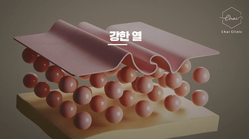 홍대 써마지 비싼돈 내는데 제대로 받아야죠 고르는기준 3가지 관련 이미지 3