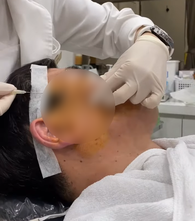 Recommended Treatments for Nasolabial Folds (Ulthera/Thermage/EMFACE/Juvelook Volume/Thread Lifting) image 10