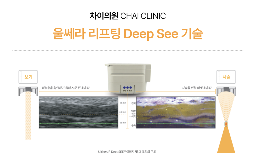 리프팅 부작용의 원인과 개선 방법 관련 이미지 1