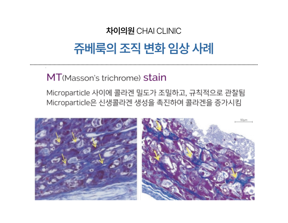 팔자주름 쥬베룩 볼륨의 유의미한 효과 관련 이미지 1