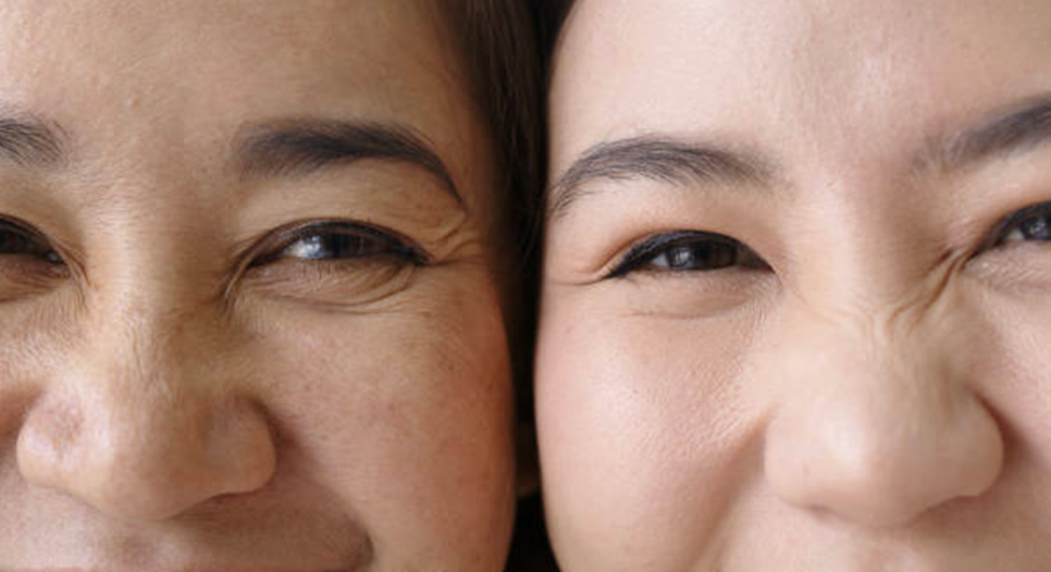 눈가 리프팅 실패 없이 효과 제대로 보고 싶다면! 관련 이미지 5