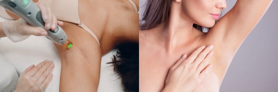 겨드랑이 레이저토닝 자신있게 핸즈업하려면 지켜야 할 것 관련 이미지 2