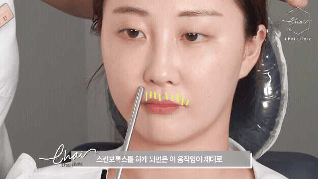 Hongdae Skin Botox Side Effects and 3 Precautions for the Procedure image 8