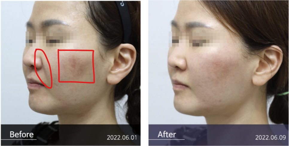 How to Achieve Thermage-Like Results with Corage Lifting image 11