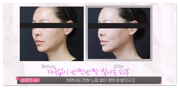 How to Choose a Good Lala Peel Clinic in Hongdae (What to Check During Your Consultation) image 10