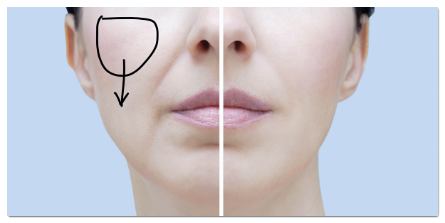 Recommended Treatments for Nasolabial Folds (Ulthera/Thermage/EMFACE/Juvelook Volume/Thread Lifting) image 2