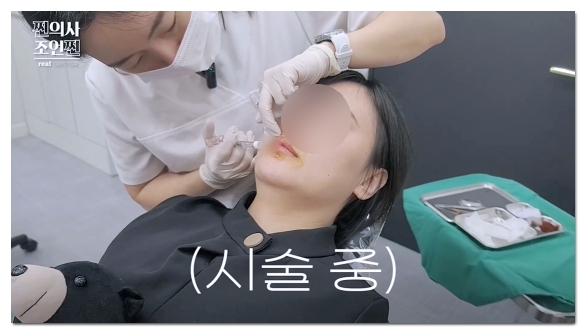 Lip Filler 1cc Before and After: Pain, Duration, and Precautions image 2