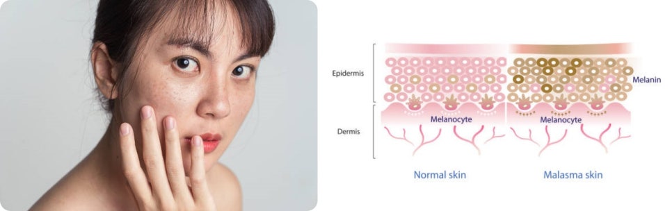 피코레이저 가격, 색소침착을 효과적으로 개선 하고 싶다면 관련 이미지 3