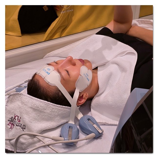 Recommended Treatments for Nasolabial Folds (Ulthera/Thermage/EMFACE/Juvelook Volume/Thread Lifting) image 7