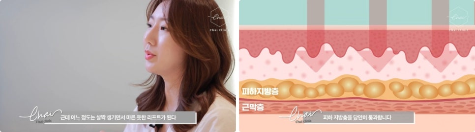 문신지우기? 레이저로 확실히 조사놔야~ 깨끗해질 수 있어요^^ 관련 이미지 5