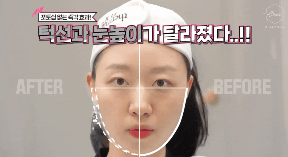 얼굴살시술 매끈하고 예쁜 라인으로 돌아가는 방법 관련 이미지 10