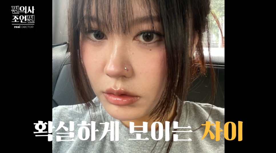 홍대 입술필러 오리입 안되려면 확인해야 할 3가지 관련 이미지 7