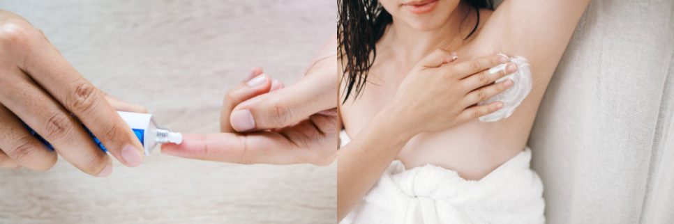 겨드랑이보톡스 다한증 치료에 효과적! 관련 이미지 6
