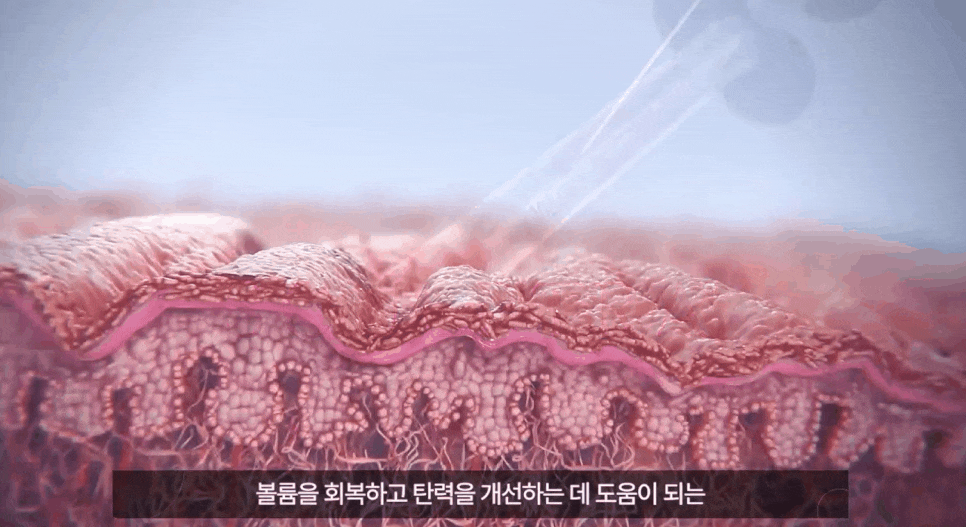 얼굴형시술 갸름하고 예쁜 브이라인 만들기 관련 이미지 4