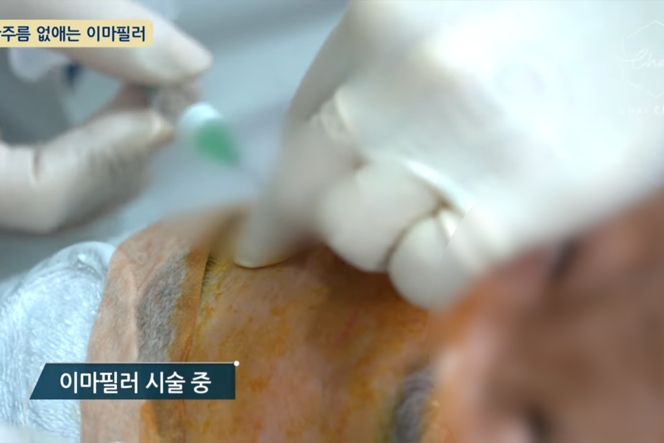 합정 필러 보톡스와 다른 점은? 관련 이미지 5
