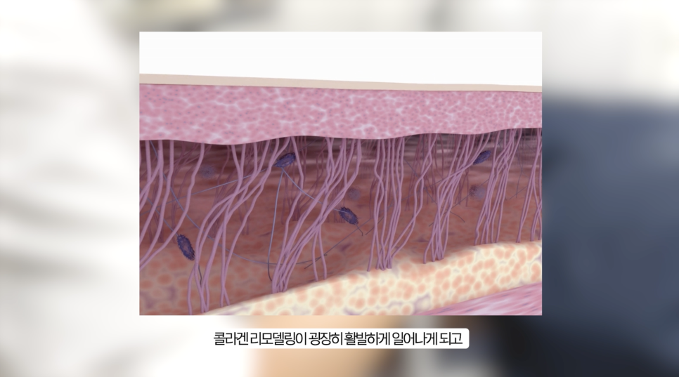슈링크 유니버스 효과를 높이는 레이어 리프팅 관련 이미지 14