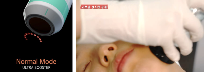 슈링크 울쎄라 8년차 의료진이 쉽게 설명해드릴게요 관련 이미지 4