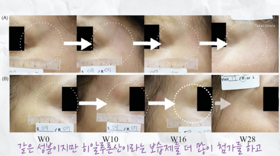 리쥬란 HB 통증에 대한 견해 관련 이미지 2