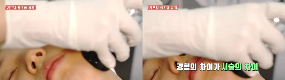 볼살시술 차이의원 조각주사로 한번에 해결! 관련 이미지 7