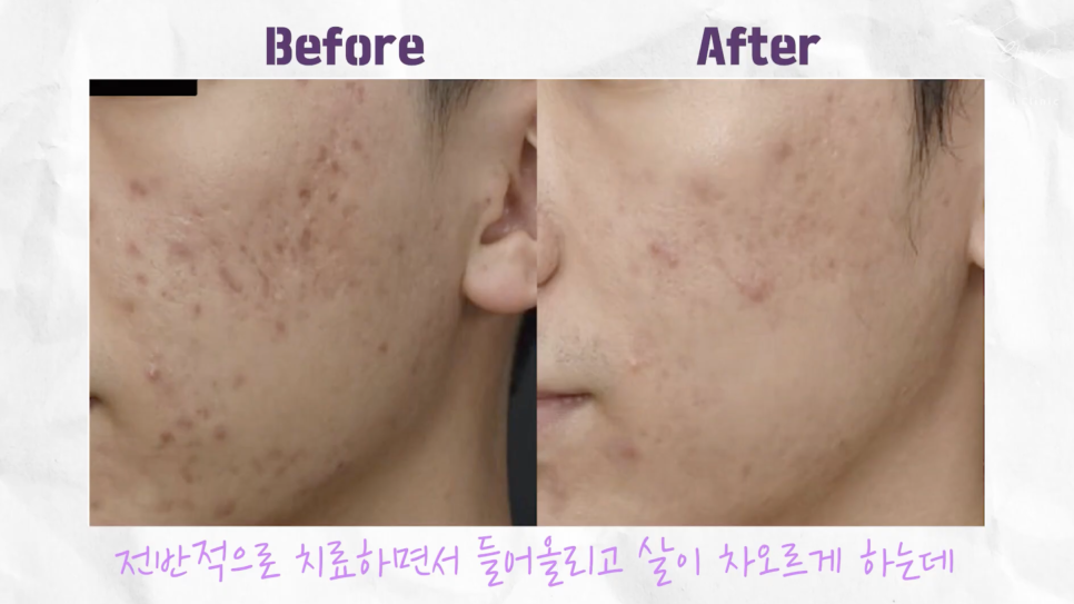 쥬베룩 성분에 따른 콜라겐 생성 촉진 효과 관련 이미지 6