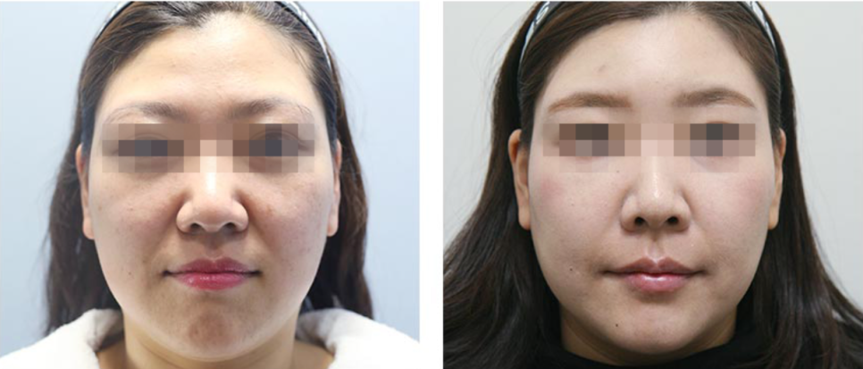 Hongdae Nose Filler Side Effects: Don’t Regret It — Get It Done Like This image 7