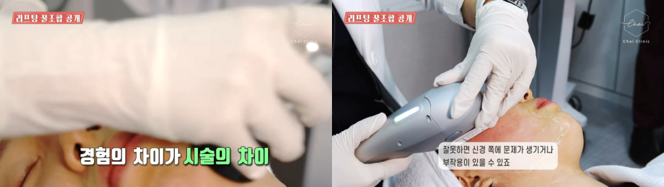 홍대슈링크 리프팅 맛집 찾으세요? 관련 이미지 3