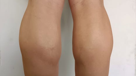 종아리보톡스 슬림한 다리 라인 원한다면! 관련 이미지 1