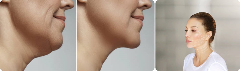 실루엣소프리프팅, 젊음의 생생함을 찾고 싶은 여러분에게 소개합니다. 관련 이미지 3