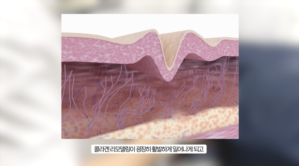 슈링크 유니버스 효과를 높이는 레이어 리프팅 관련 이미지 13