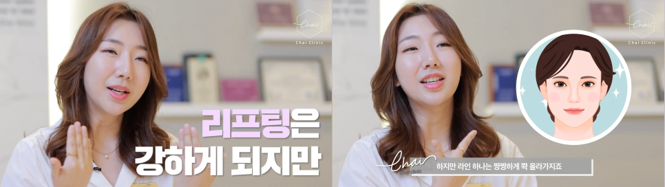 울쎄라팔자주름 울쎄라 실력자가 강조하는 &lsquo;이것&rsquo;! 관련 이미지 8